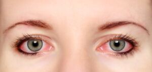 conjuntivitis shutterstock
