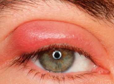 Img Chalazion