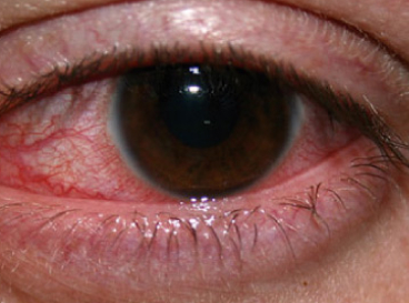 Img Queratitis