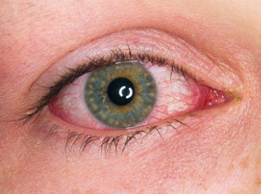 Img Uveitis