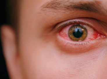 Img conjuntivitis
