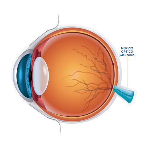 Img glaucoma