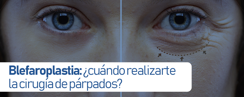 blefaroplastia