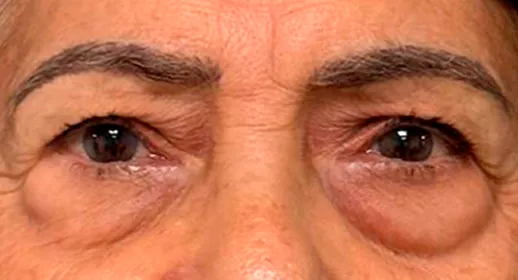 Párpados superiores e inferiores antes de la blefaroplastia de cuatro párpados en VIU