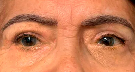 Los mismos párpados después de la blefaroplastia de cuatro párpados