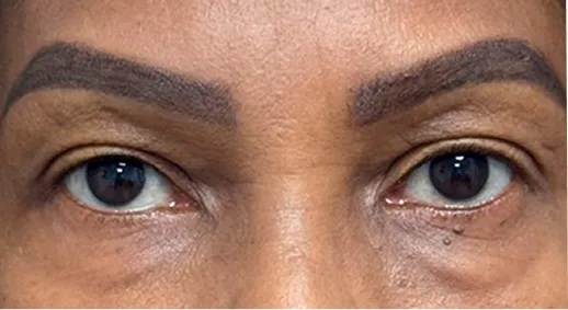 Los mismos párpados inferiores después de la blefaroplastia
