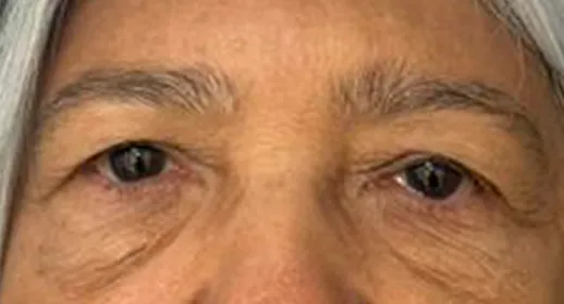 Párpados superiores con exceso de piel sobre el pliegue, antes de la blefaroplastia en VIU