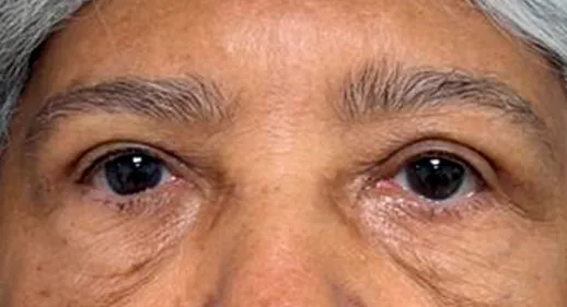 Los mismos párpados superiores después de la blefaroplastia