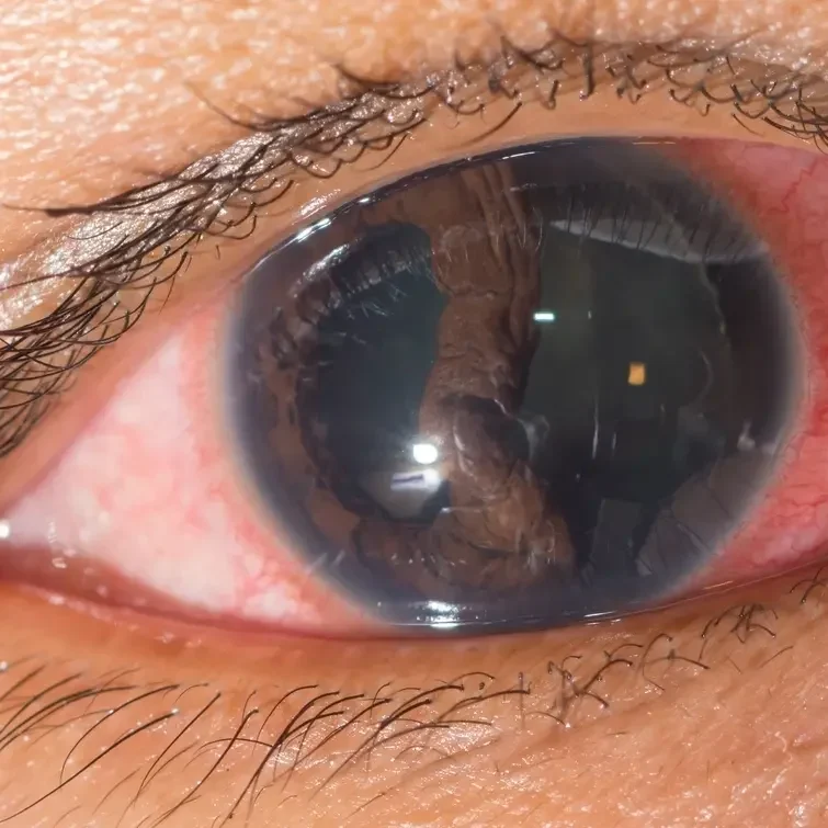 Cirugía de Desprendimiento de retina en Barranquilla Colombia en VIU Clínica Oftalmológica internacional en Barranquilla Colombia