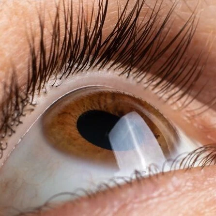 Trasplante de Cornea en Colombia en VIU Clínica Oftalmológica Internacional en Barranquilla Colombia