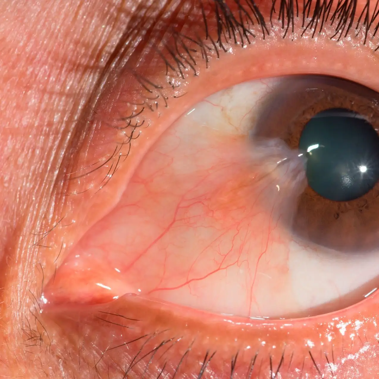 Tratamiento para la carnosidad en los ojos - Cirugía de pterigion en VIU - Clínica Oftalmológica Internacional en Barranquilla Colombia